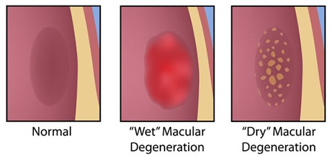 Age Related Macula Degeneration Types