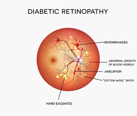 Diabetic Retinopathy