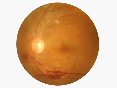 Retinal vein occlusion